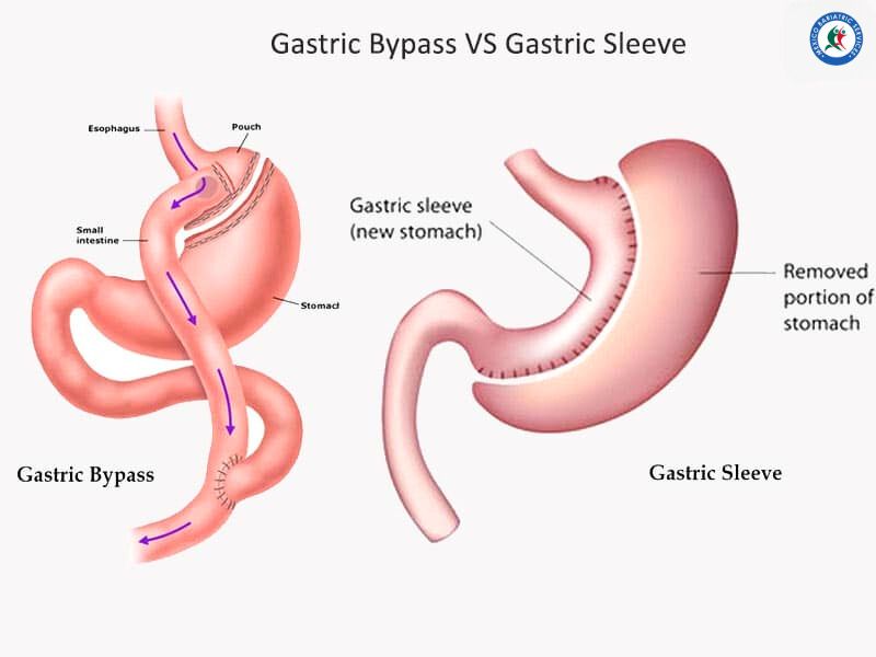 gastric-bypass-vs-gastric-sleeve | Gastric Sleeve in Reynosa