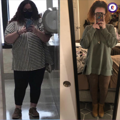 Before and After- Weight loss surgery in Tijuana, Mexico