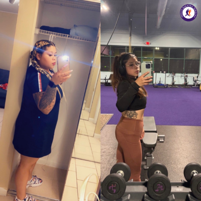 Weight loss surgery in Tijuana Before and after- Weight loss surgery in Tijuana