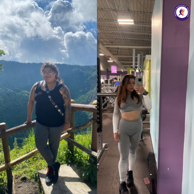 Before and after- Weight loss surgery in Tijuana, Mexico