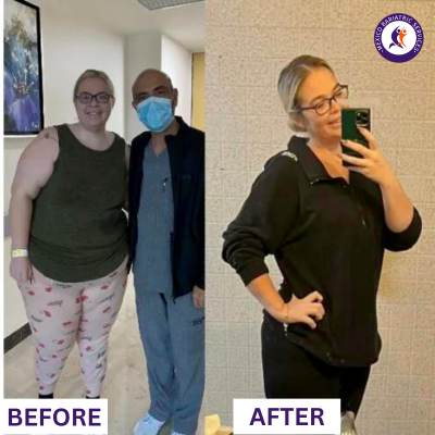 Before & After Gastric Bypass in Puerto Vallarta Before & After Gastric Bypass in Puerto Vallarta