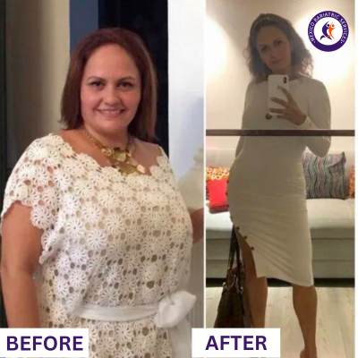 Before & After Gastric Bypass in Puerto Vallarta Before & After Gastric Bypass in Puerto Vallarta