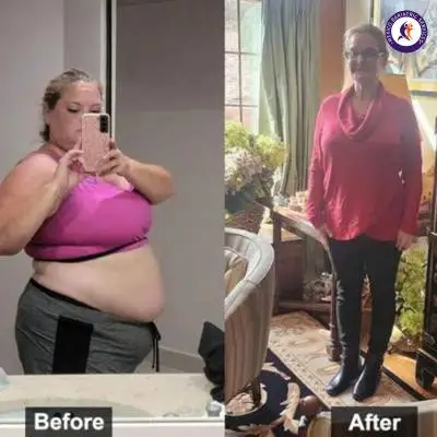 Before & After Gastric sleeve in Tijuana, Nicole Parker shed 136 pounds