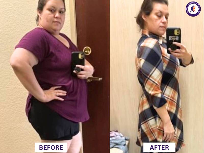 Dr. Galileo Villarreal Before after, Kimberly lost 100LB with gastric sleeve surgery in 7 months