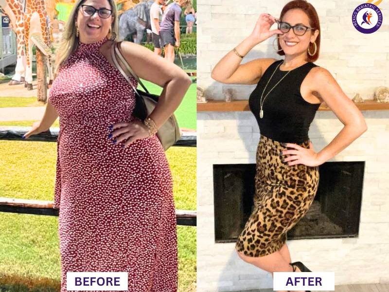 Dr. Galileo Villarreal Before after, Alejandra Zacarías lost 100LB with gastric sleeve surgery
