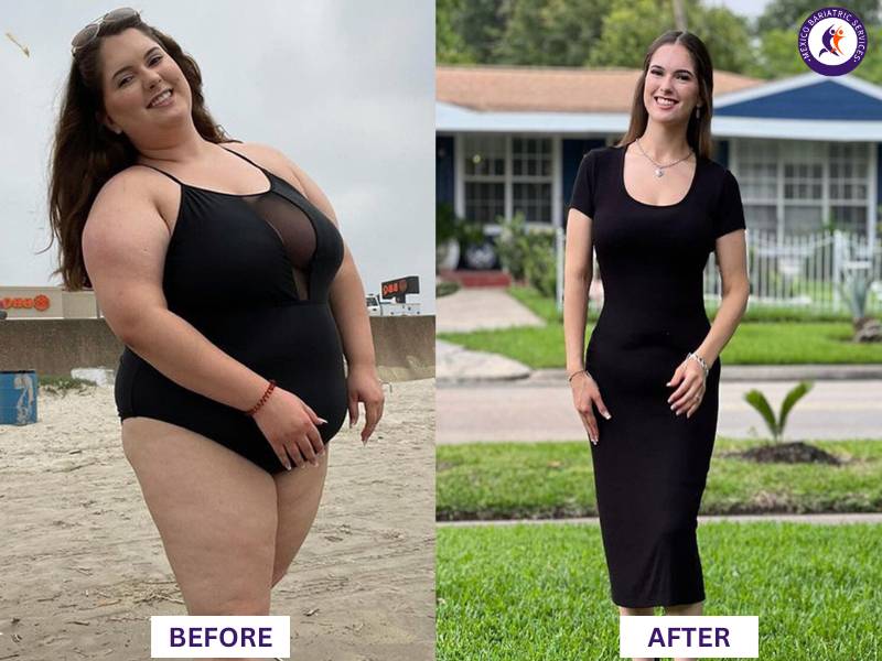 Dr. Galileo Villarreal Before after, Brianna lost 90LB with gastric bypass surgery