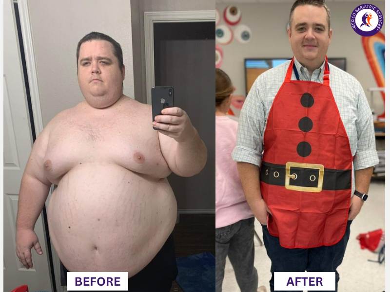 Dr. Galileo Villarreal Before after, Alex D'Amico lost 140LB with gastric sleeve surgery