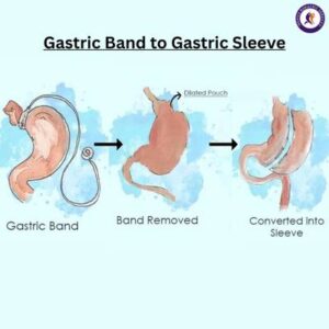 Gastric band to gastric sleeve revision weight loss surgery in Guadalajara