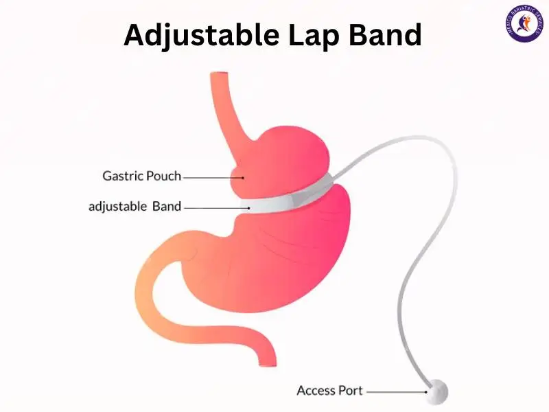 Gastric Band in Tijuana by Dr. Luis Cazares