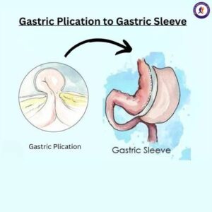 Gastric Plication to Gastric Sleeve, revision weight loss surgery in Guadalajara