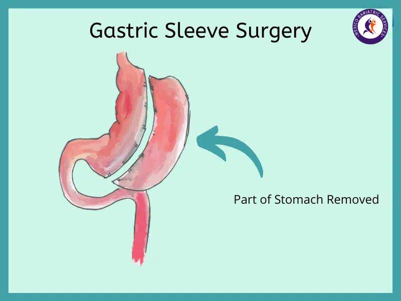 Gastric Sleeve in Cancun