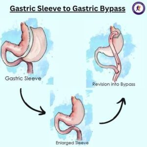 Gastric Sleeve to Gastric Bypass revision weight loss surgery in Guadalajara