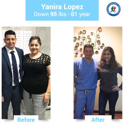 Gastric sleeve Nuevo Laredo Before After, Yanira Lopez shed 95 lbs in 1 years