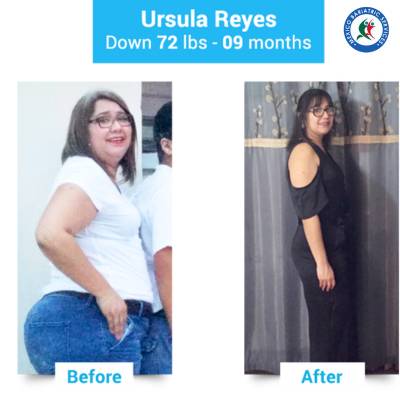 Gastric Sleeve in Nuevo Laredo Gastric sleeve Nuevo Laredo Before After, Ursula Reyes shed 72 lbs in 9 months