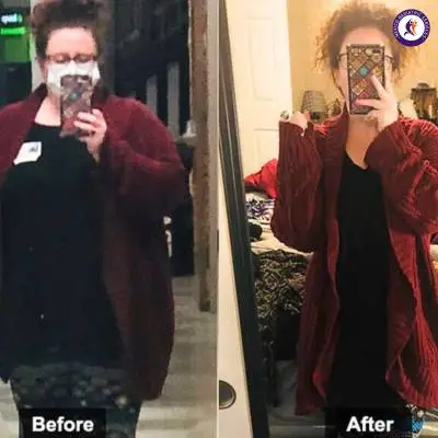 Gastric sleeve in Tijuana, Before after, Janelle Woodburn lost  90 lbs in 17 months,