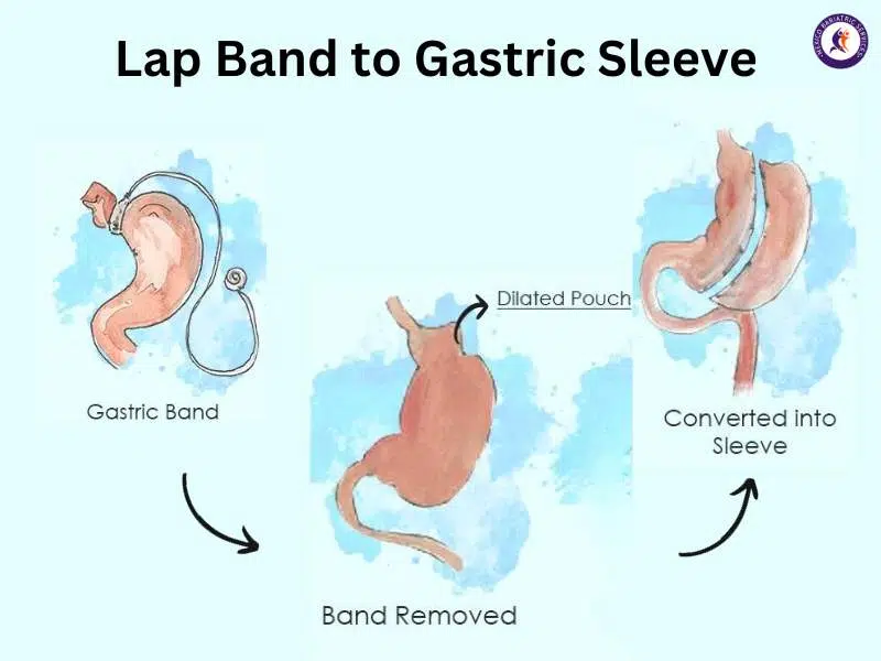 Lap Band to Gastric Sleeve in Tijuana by Dr. Luis Cazares