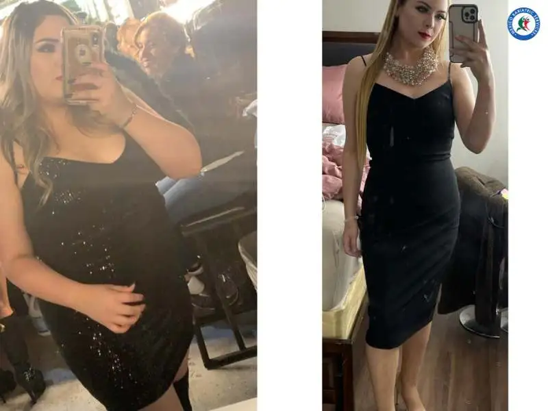 Before & After Gastric Sleeve in Reynosa Before & After Gastric Sleeve in Reynosa