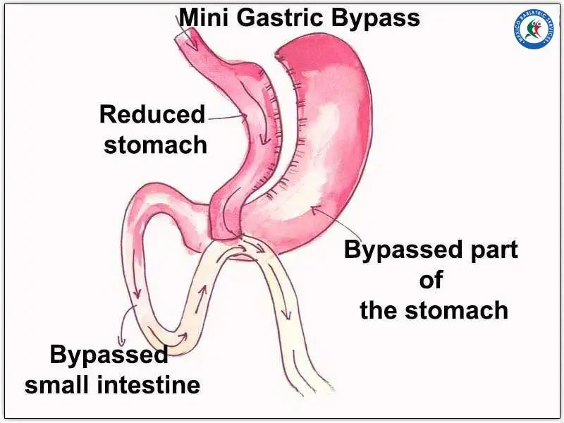Mini Gastric Bypass in Mexico