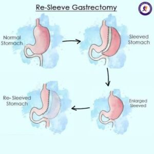 Gastric Re-sleeve, Revision weight loss surgery in Guadalajara