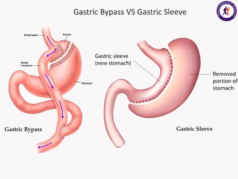 Gastric Bypass vs Gastric Sleeve Gastric Sleeve vs Gastric Bypass