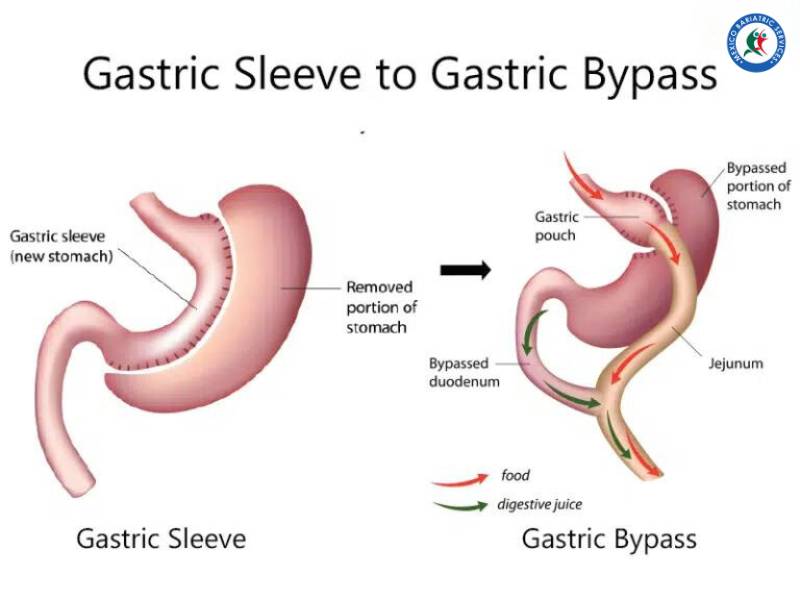 Gastric sleeve to gastric bypass revision weight loss surgery in Puerto Vallarta