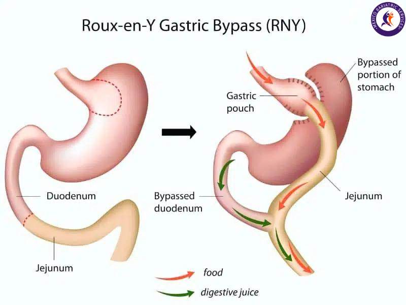 Gastric Bypass in Cancun