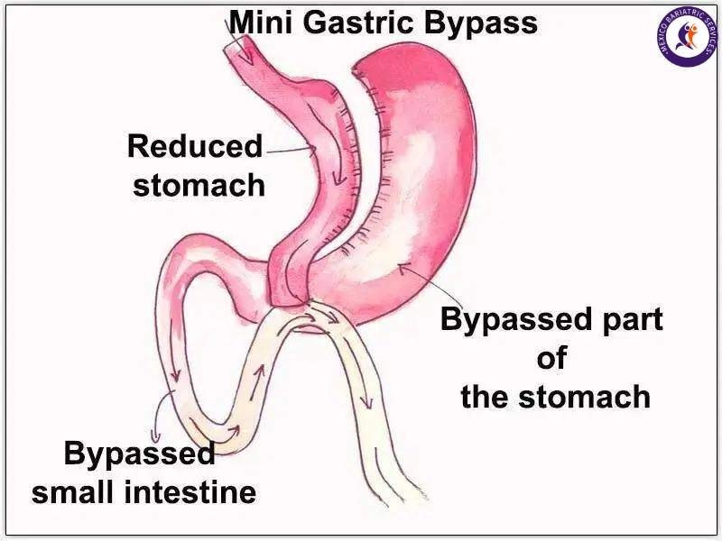 Mini Gastric Bypass Surgery
