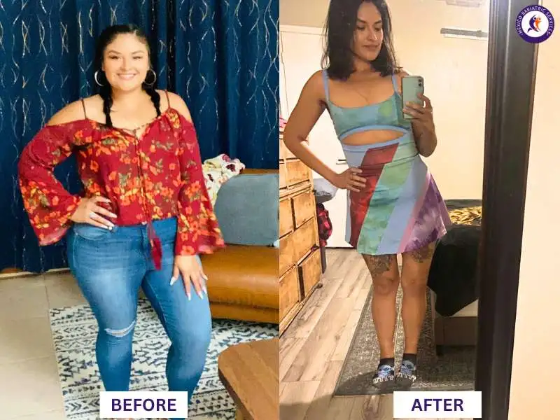 Vania Moncayo Gastric Sleeve in Tijuana Before and After by Dr. Luis Cazares