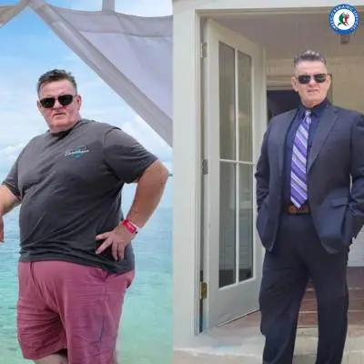 Revision weight loss surgery, Puerto Vallarta, before and after