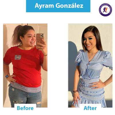 Ayram Gonzalez had Mini Gastric Bypass in Mexico