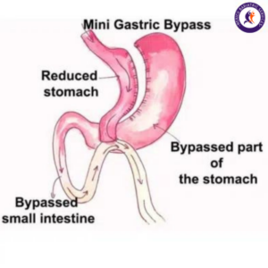 Mini Gastric Bypass Surgery for Weight loss surgery in Puerto Vallarta