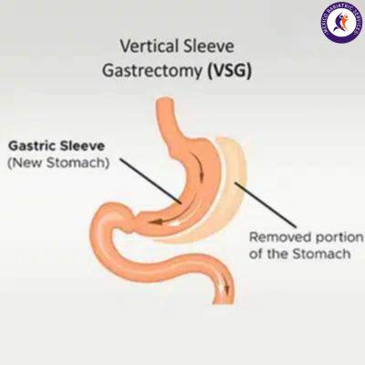 Gastric Sleeve for weight Loss Surgery in Puerto Vallarta