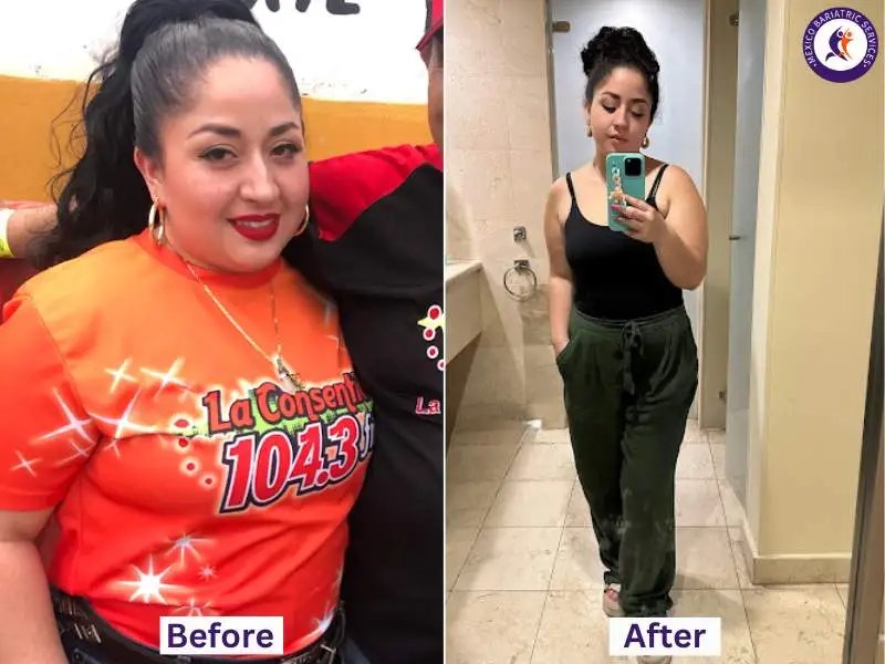 Daniela's before and after with gastric sleeve in piedras negras