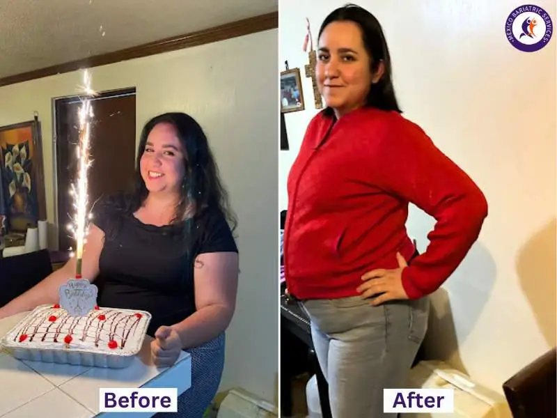 Gastric Sleeve Surgery in Piedras Negras | Before & After Gastric sleeve in Piedras Negras helped Eloisa achieve amazing results in just 1.5 months!
