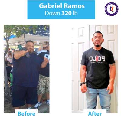 Gabriel Ramos lost 320 lbs with MGB in Mexico