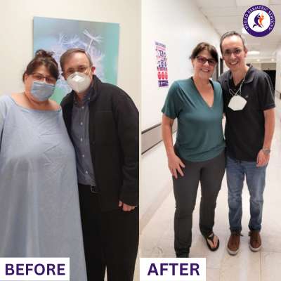 Before & After Gastric Balloon in Mexico Gastric Balloon in Cancun, Mexico