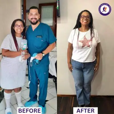 Gastric Bypass in Guadalajara Before and After