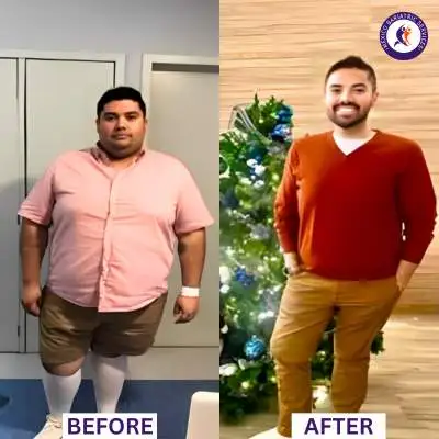 Gastric Bypass in Guadalajara Before and After