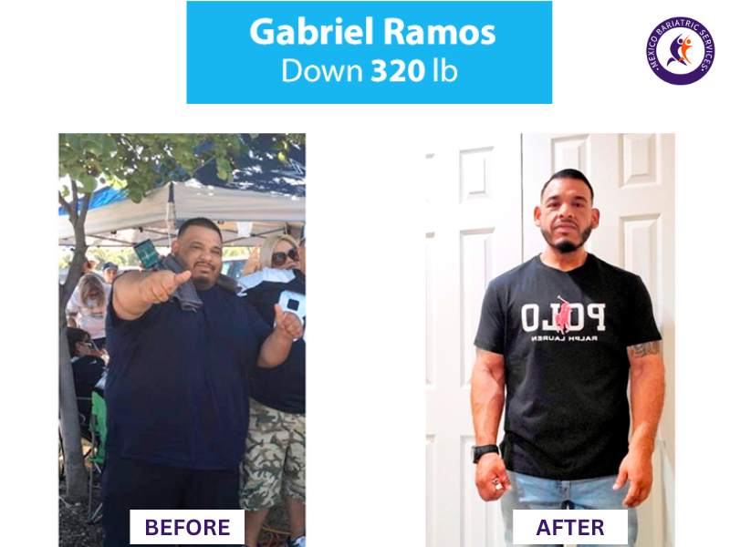 Weight loss surgery in Nuevo Laredo Before and After