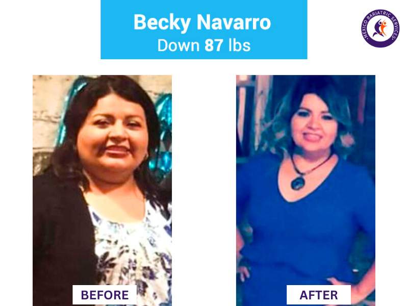 Weight loss surgery in Nuevo Laredo Before and After