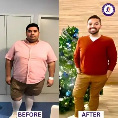 Weight Loss Surgery, Before & After Before & After
