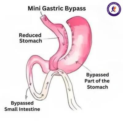 Mini Gastric Bypass Mini Gastric Bypass