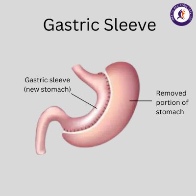 Gastric Sleeve Gastric Sleeve