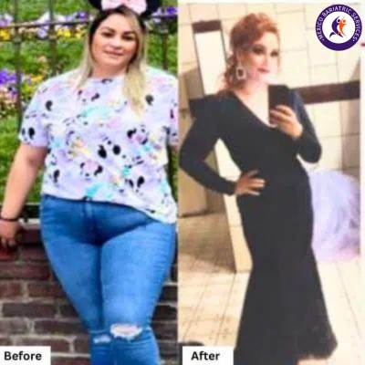 Weight Loss Surgery, Before & After Before & After
